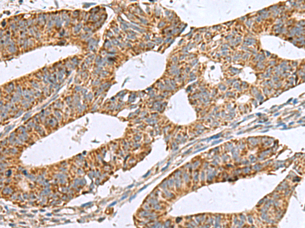 Immunohistochemistry of paraffin-embedded Human colorectal cancer tissue  using NFS1 Polyclonal Antibody at dilution of 1:50(×200)