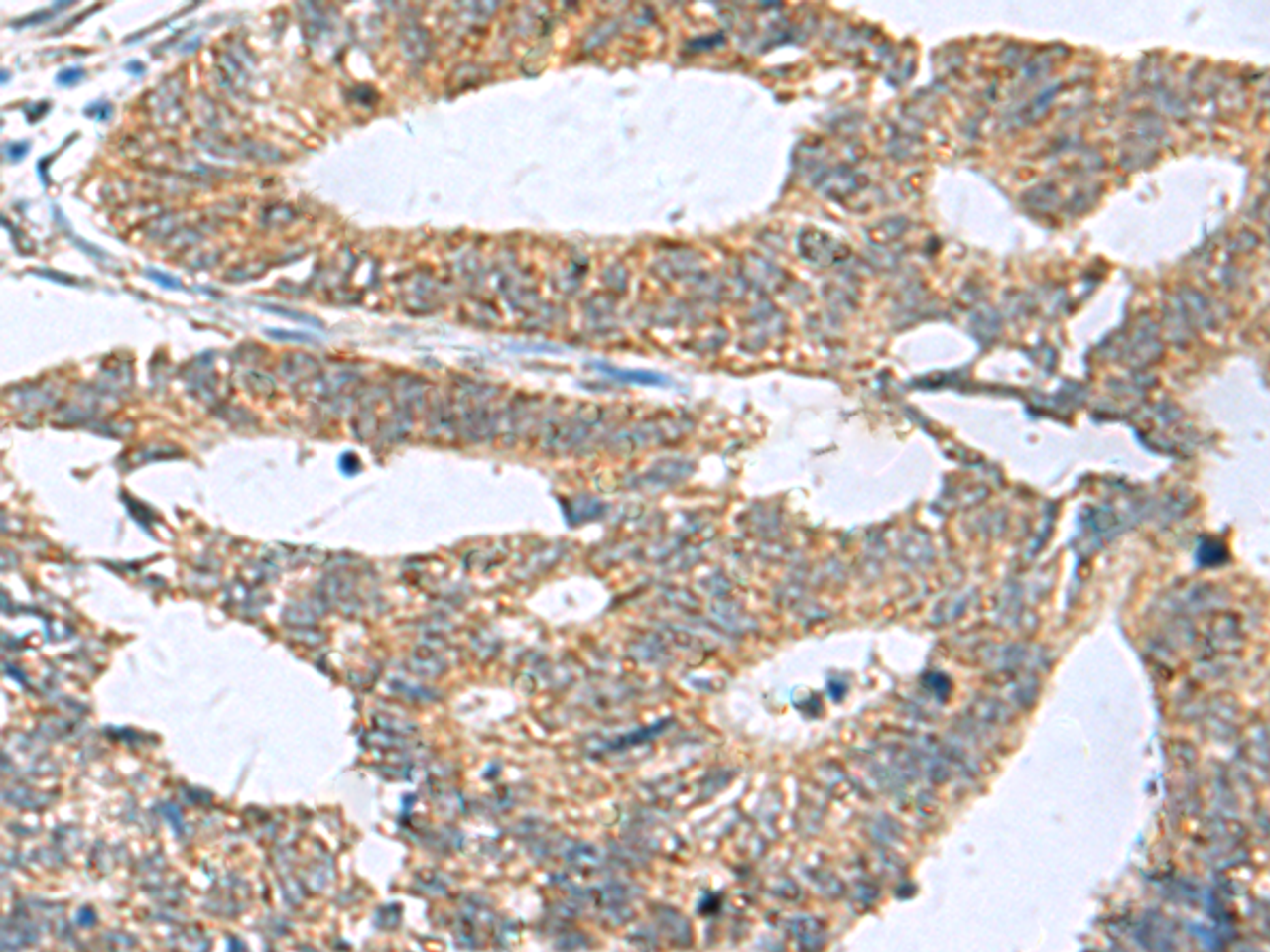 Immunohistochemistry of paraffin-embedded Human colorectal cancer tissue  using HPCAL1 Polyclonal Antibody at dilution of 1:70(×200)