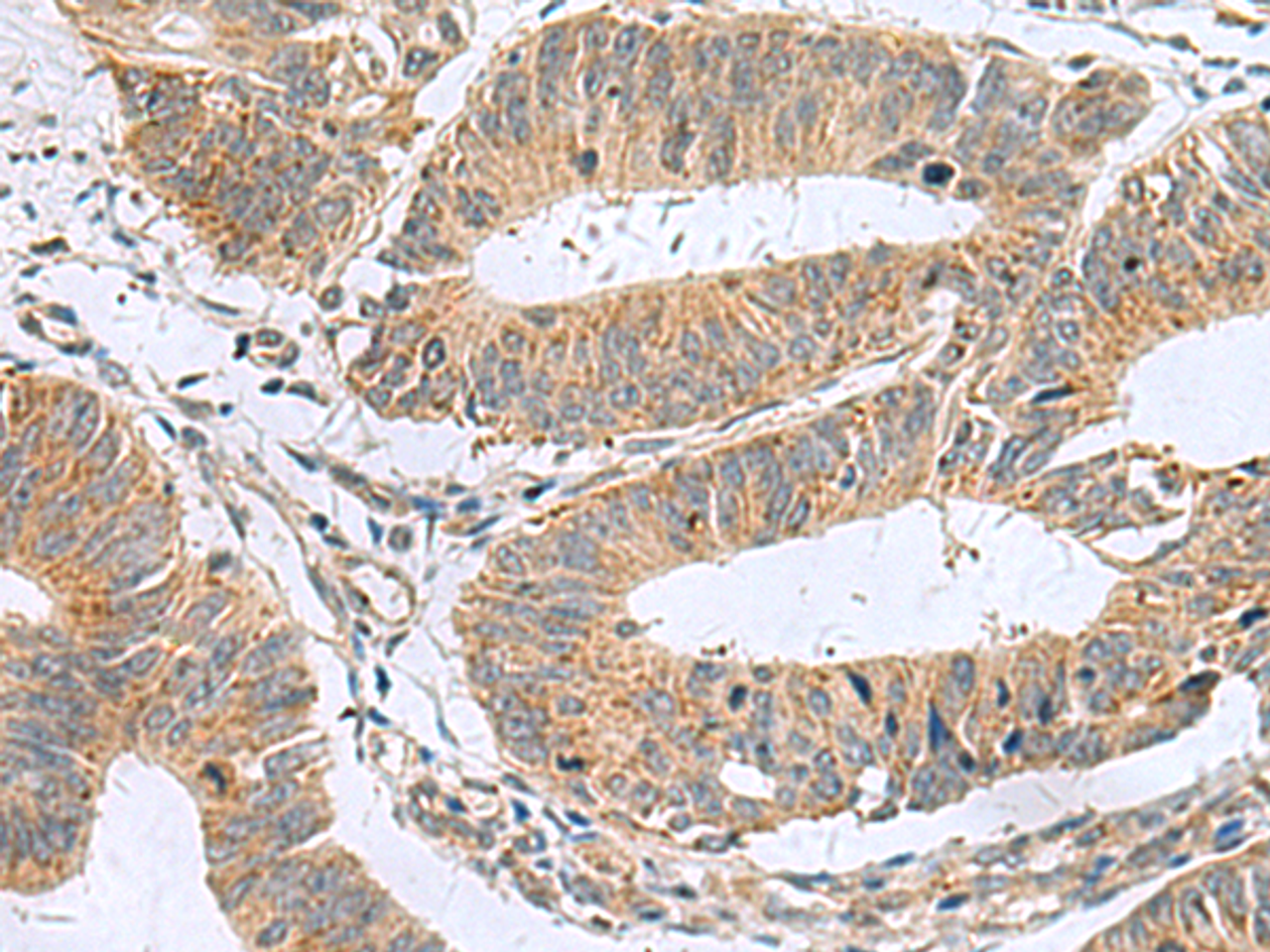 Immunohistochemistry of paraffin-embedded Human colorectal cancer tissue  using MARCKSL1 Polyclonal Antibody at dilution of 1:50(×200)