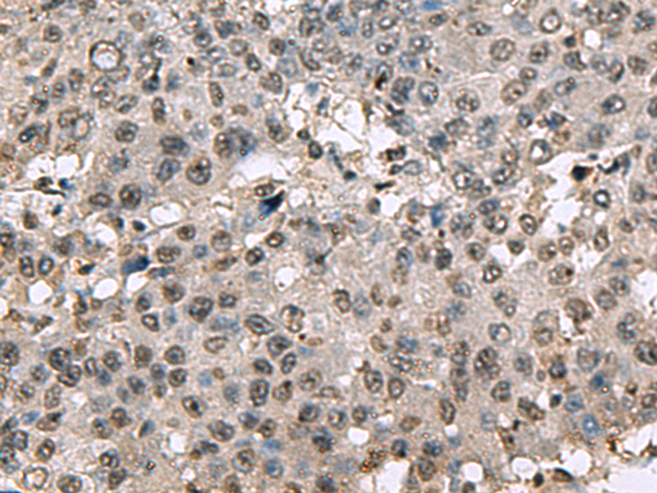 Immunohistochemistry of paraffin-embedded Human liver cancer tissue  using TMX3 Polyclonal Antibody at dilution of 1:70(×200)