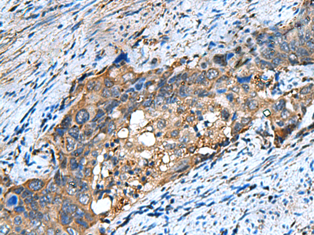 Immunohistochemistry of paraffin-embedded Human cervical cancer tissue  using COMMD9 Polyclonal Antibody at dilution of 1:60(×200)