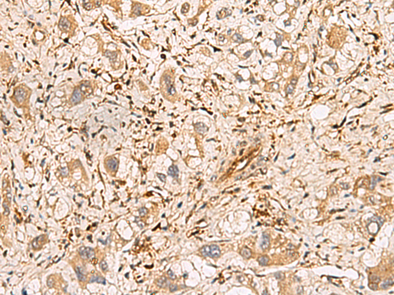 Immunohistochemistry of paraffin-embedded Human liver cancer tissue  using PLCB2 Polyclonal Antibody at dilution of 1:60(×200)