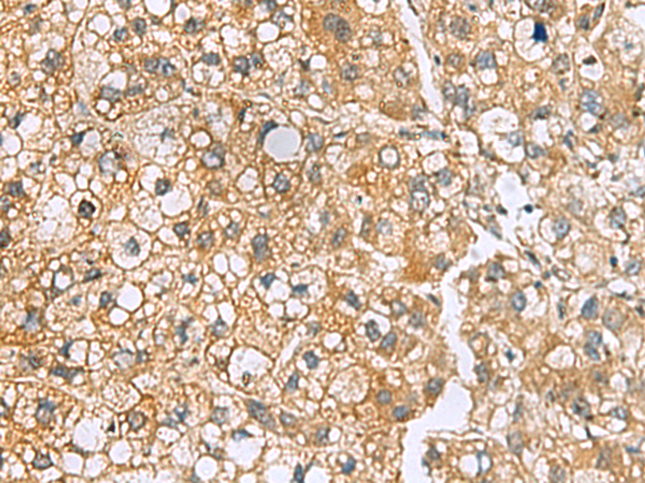 Immunohistochemistry of paraffin-embedded Human liver cancer tissue  using MRPL22 Polyclonal Antibody at dilution of 1:50(×200)