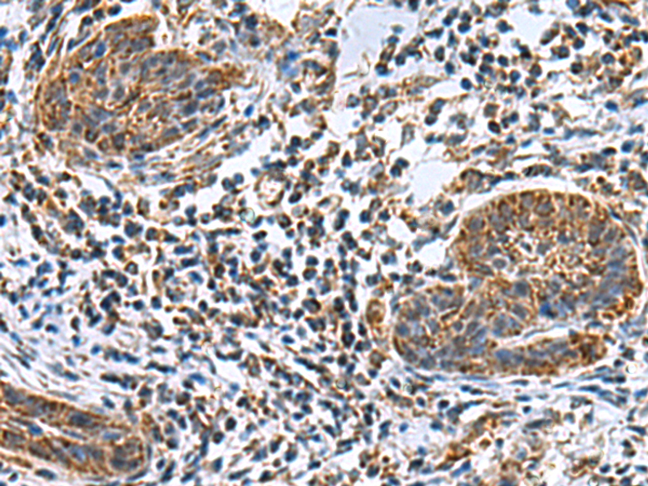 Immunohistochemistry of paraffin-embedded Human esophagus cancer tissue  using MRPL40 Polyclonal Antibody at dilution of 1:80(×200)