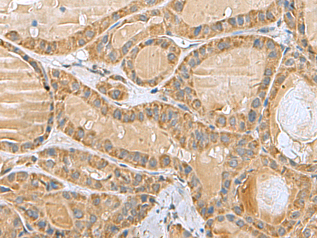 Immunohistochemistry of paraffin-embedded Human thyroid cancer tissue  using MRPL40 Polyclonal Antibody at dilution of 1:80(×200)