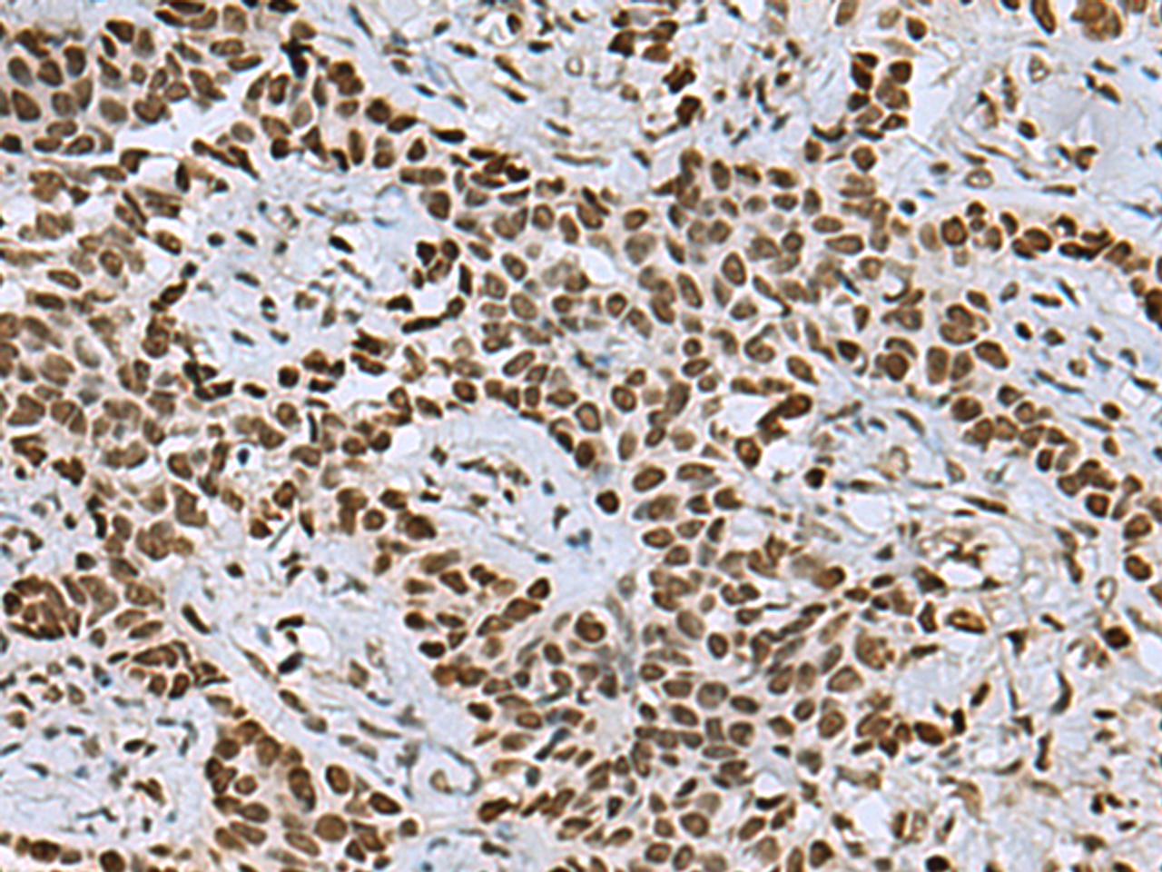 Immunohistochemistry of paraffin-embedded Human ovarian cancer tissue  using MYEF2 Polyclonal Antibody at dilution of 1:55(×200)