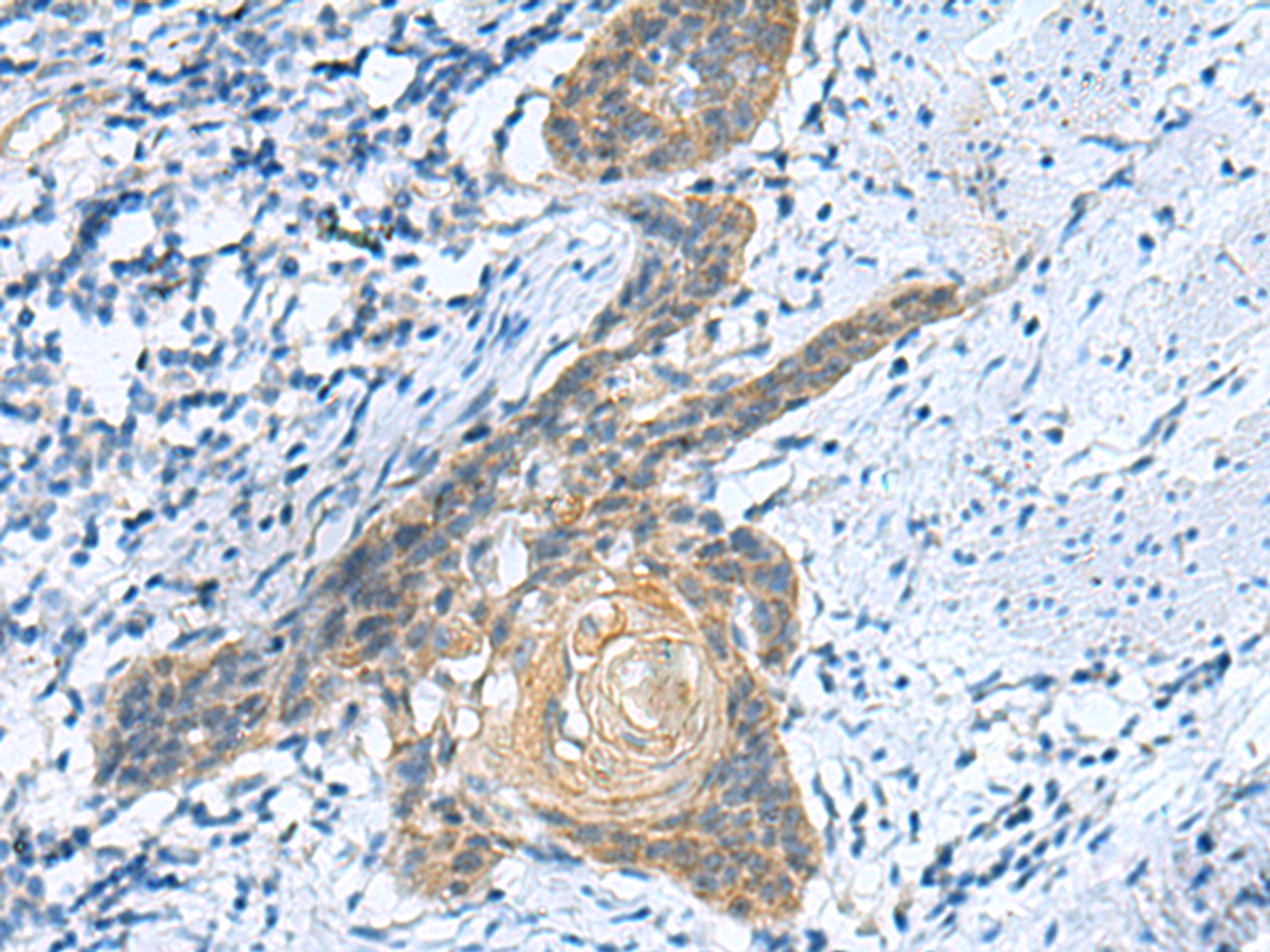 Immunohistochemistry of paraffin-embedded Human esophagus cancer tissue  using GINS3 Polyclonal Antibody at dilution of 1:50(×200)