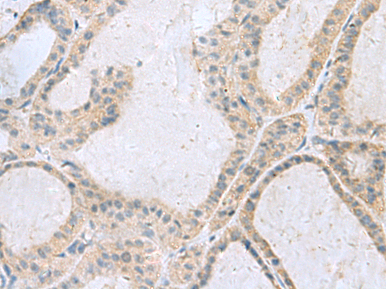 Immunohistochemistry of paraffin-embedded Human thyroid cancer tissue  using GINS3 Polyclonal Antibody at dilution of 1:50(×200)