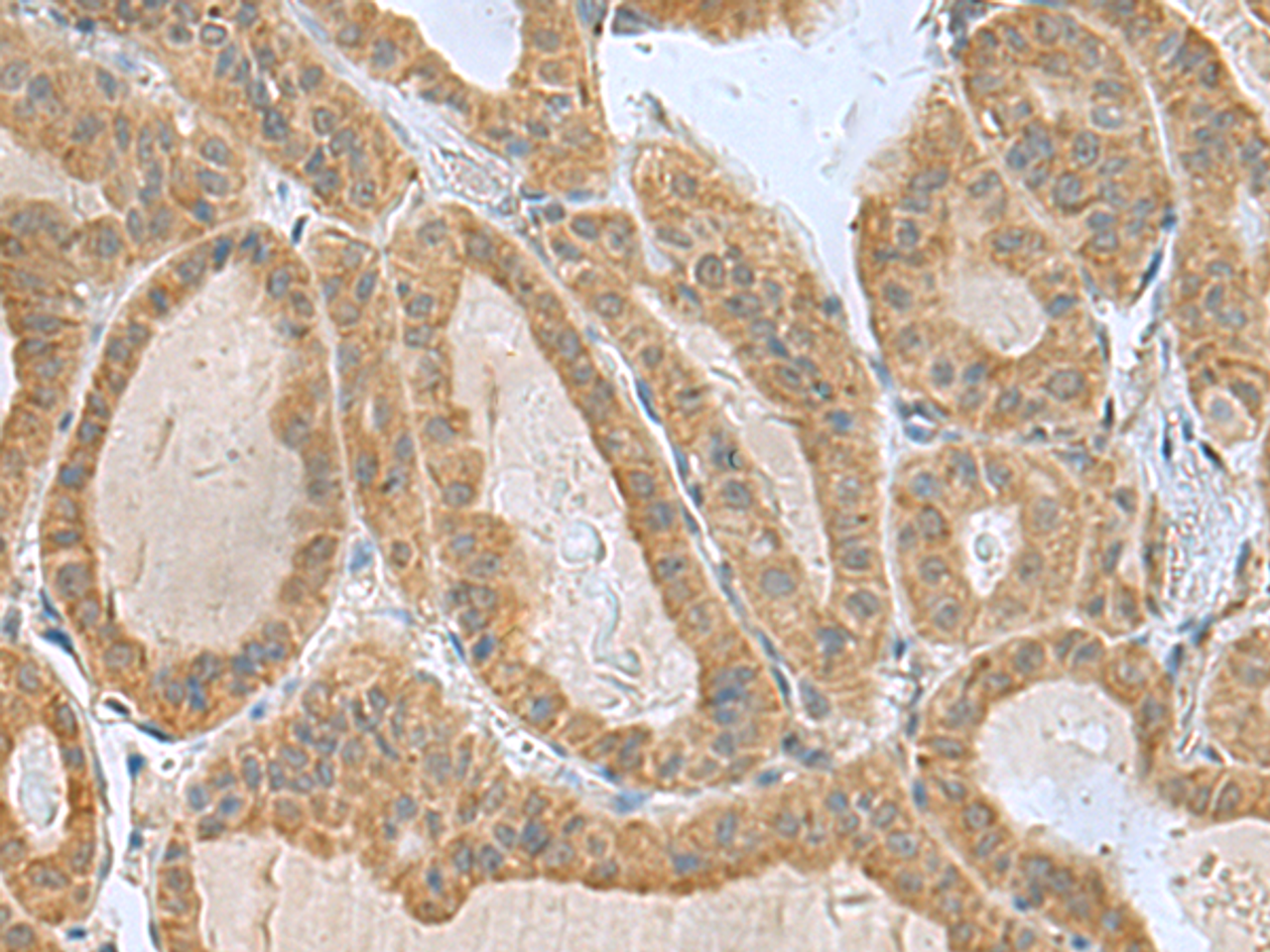 Immunohistochemistry of paraffin-embedded Human thyroid cancer tissue  using SLC30A6 Polyclonal Antibody at dilution of 1:75(×200)