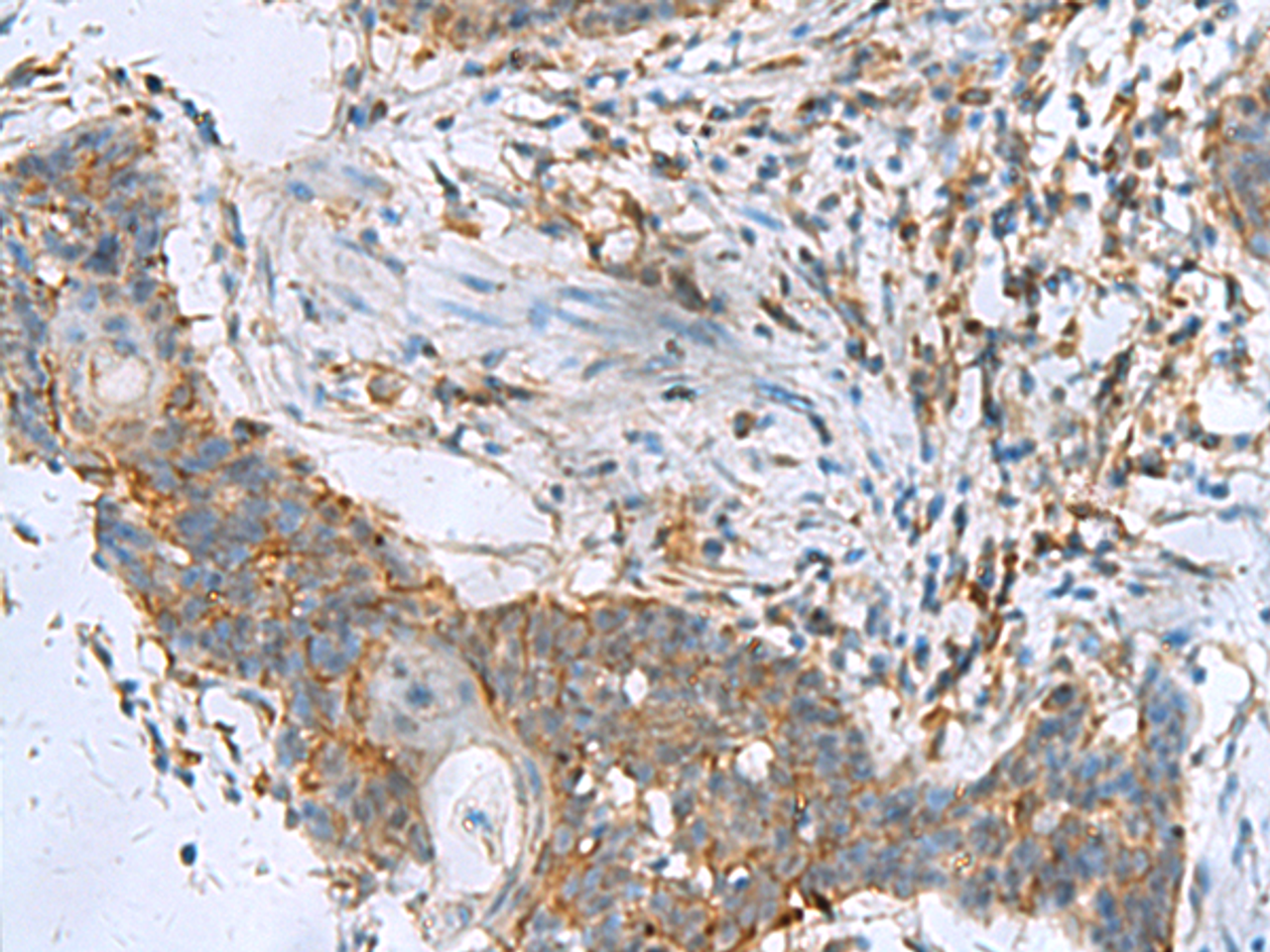 Immunohistochemistry of paraffin-embedded Human esophagus cancer tissue  using RPL10A Polyclonal Antibody at dilution of 1:50(×200)