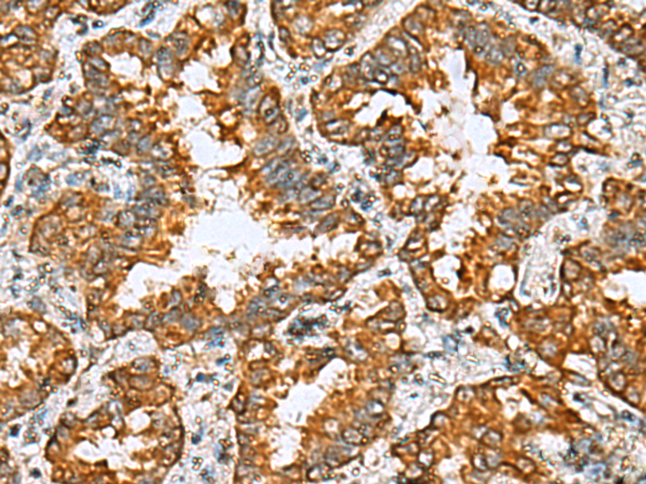 Immunohistochemistry of paraffin-embedded Human lung cancer tissue  using TMED10 Polyclonal Antibody at dilution of 1:65(×200)