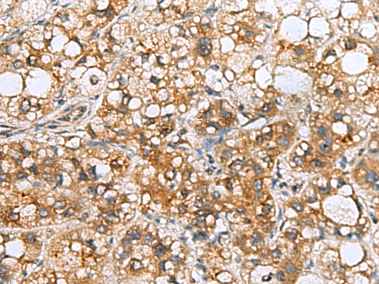 Immunohistochemistry of paraffin-embedded Human liver cancer tissue  using TMED10 Polyclonal Antibody at dilution of 1:65(×200)