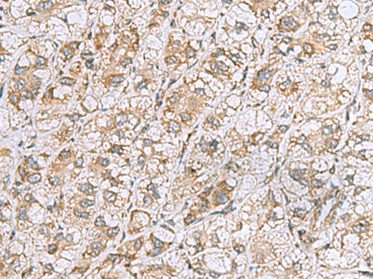 Immunohistochemistry of paraffin-embedded Human liver cancer tissue  using CCDC134 Polyclonal Antibody at dilution of 1:50(×200)