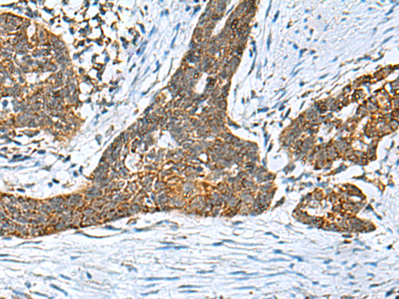 Immunohistochemistry of paraffin-embedded Human esophagus cancer tissue  using PREPL Polyclonal Antibody at dilution of 1:55(×200)