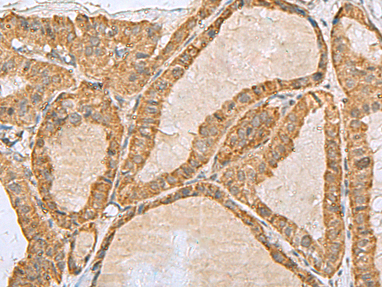 Immunohistochemistry of paraffin-embedded Human thyroid cancer tissue  using PREPL Polyclonal Antibody at dilution of 1:55(×200)