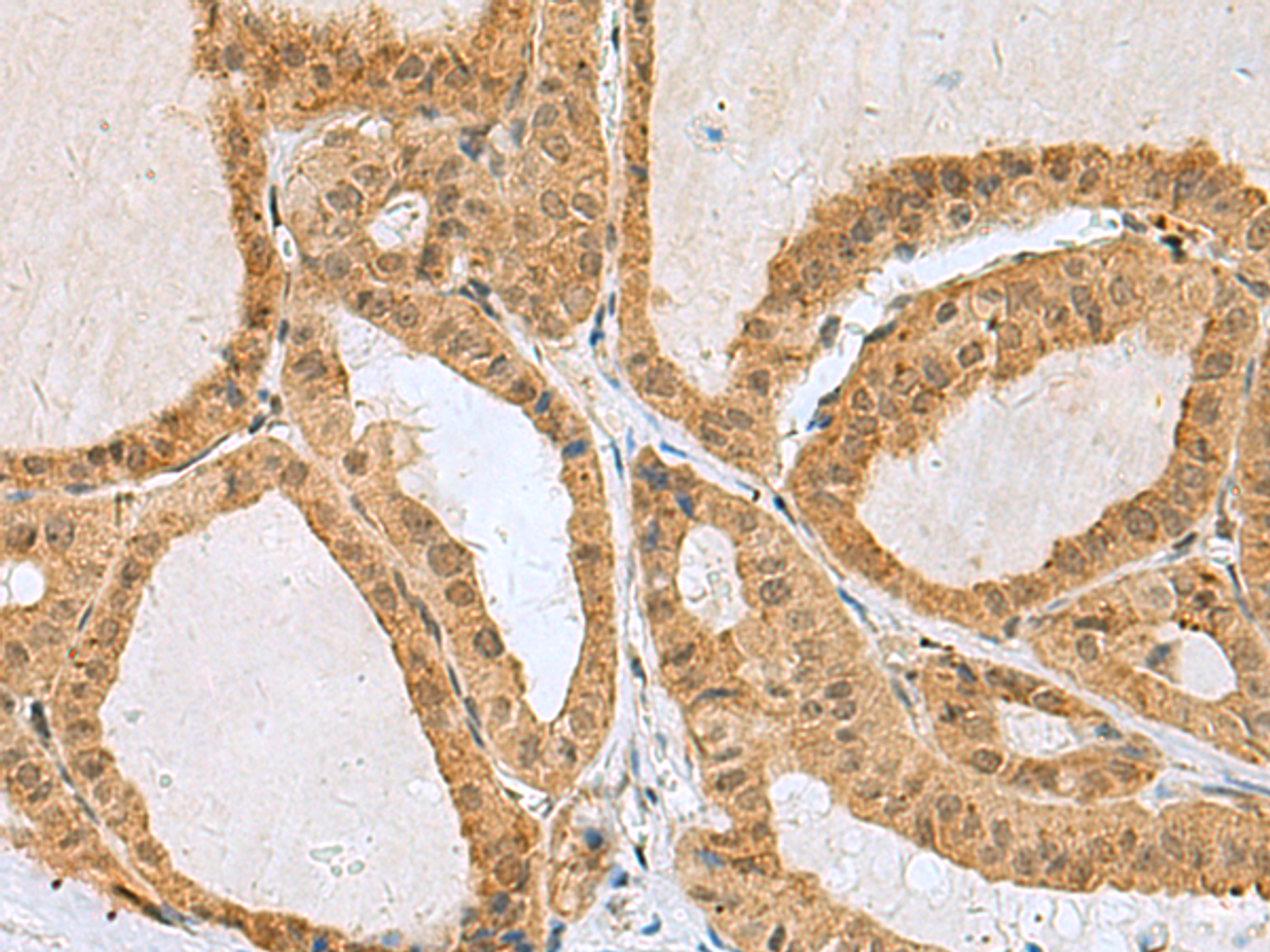 Immunohistochemistry of paraffin-embedded Human thyroid cancer tissue  using EXOSC4 Polyclonal Antibody at dilution of 1:50(×200)