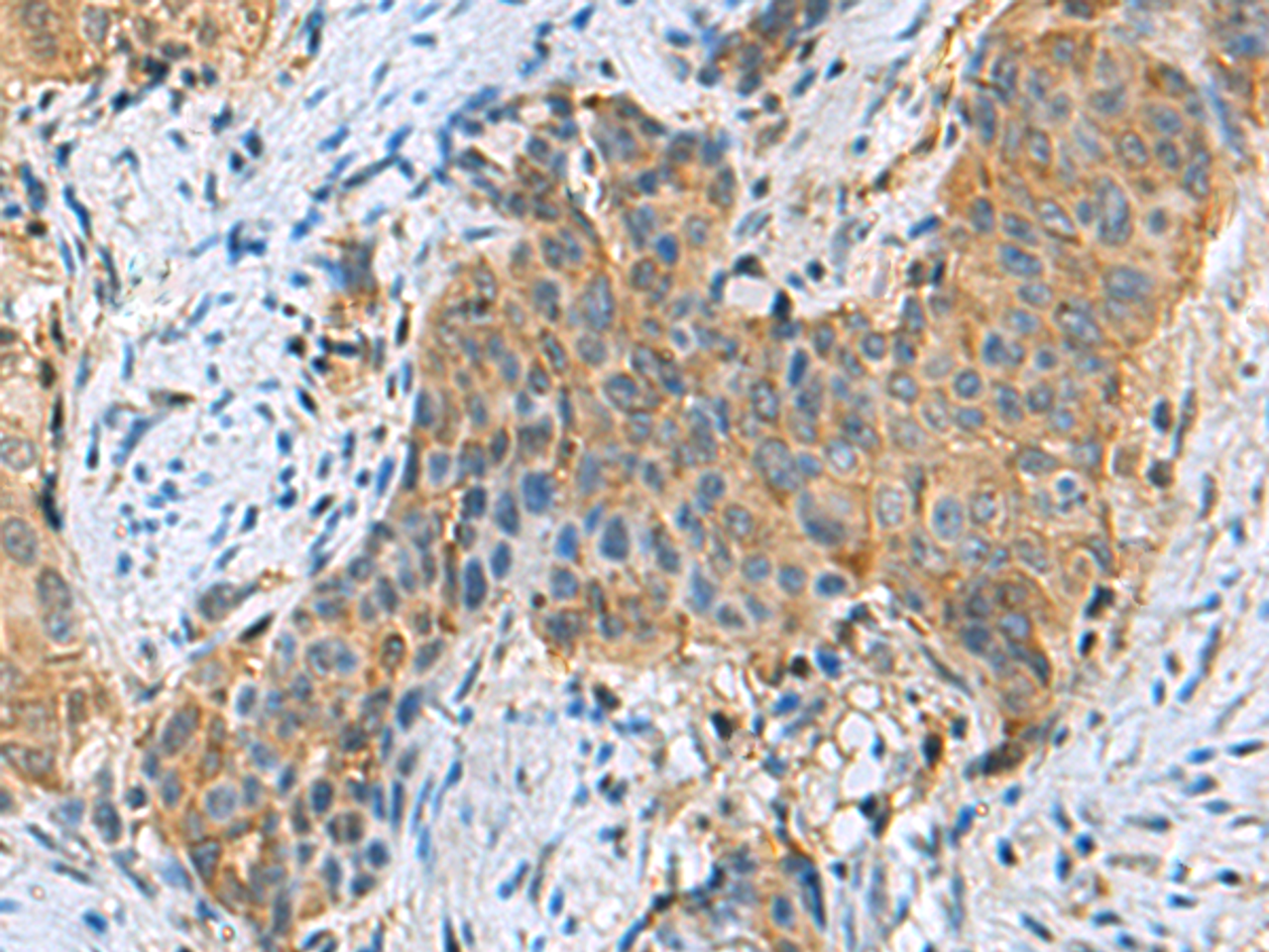 Immunohistochemistry of paraffin-embedded Human cervical cancer tissue  using PSMA6 Polyclonal Antibody at dilution of 1:90(×200)