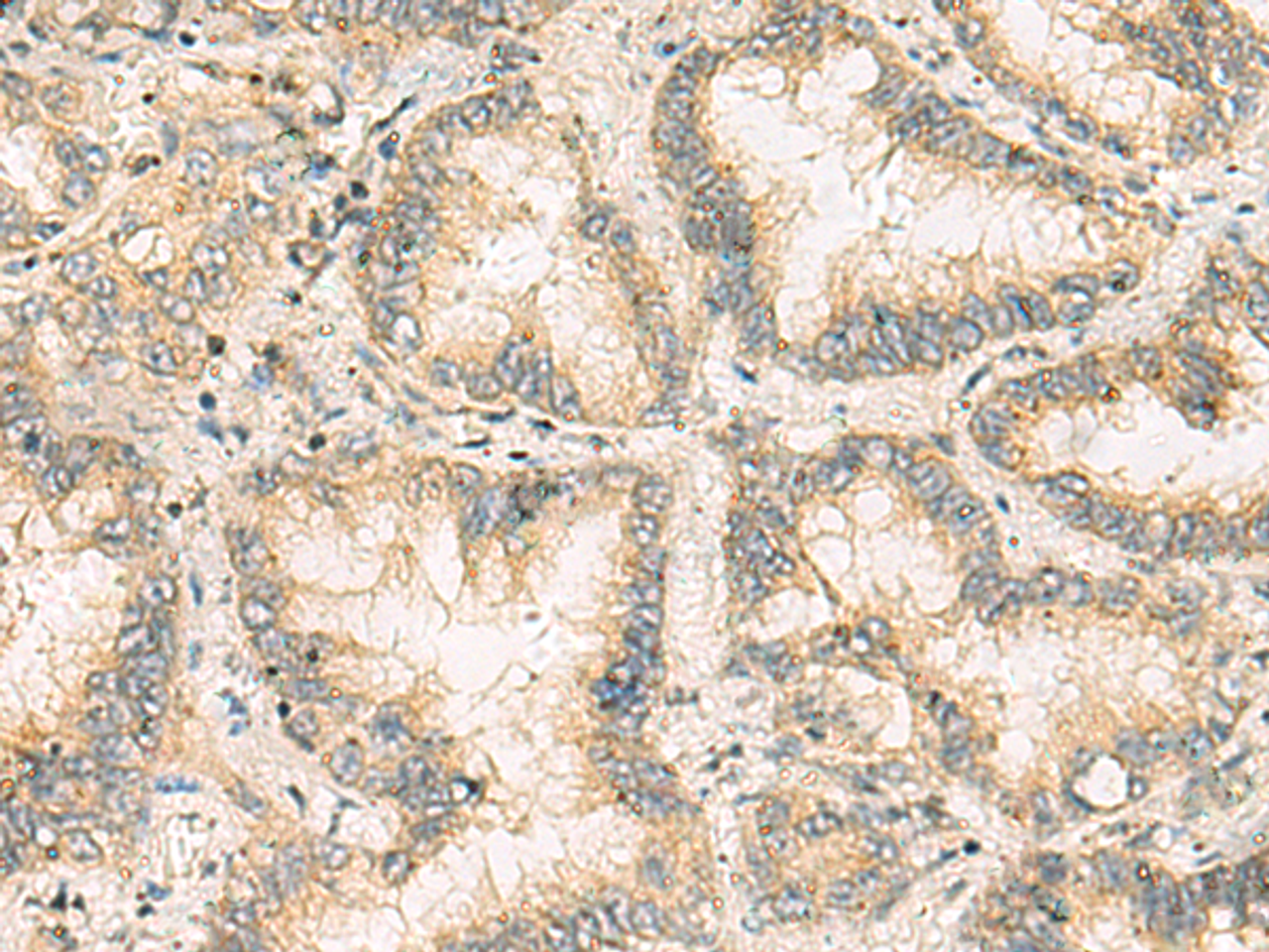 Immunohistochemistry of paraffin-embedded Human lung cancer tissue  using NANP Polyclonal Antibody at dilution of 1:65(×200)