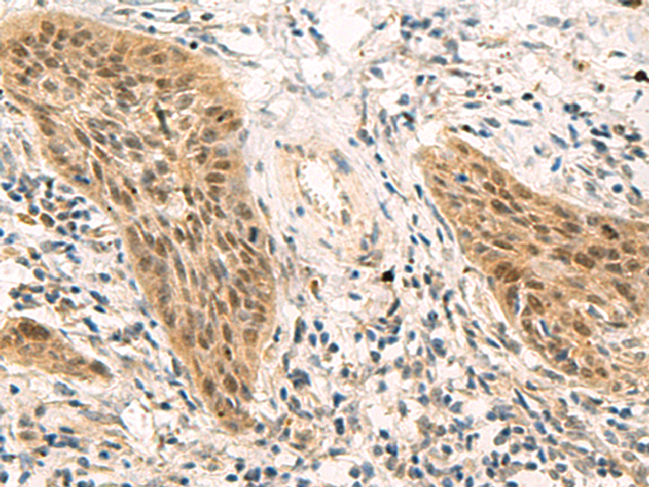 Immunohistochemistry of paraffin-embedded Human esophagus cancer tissue  using PSME1 Polyclonal Antibody at dilution of 1:50(×200)