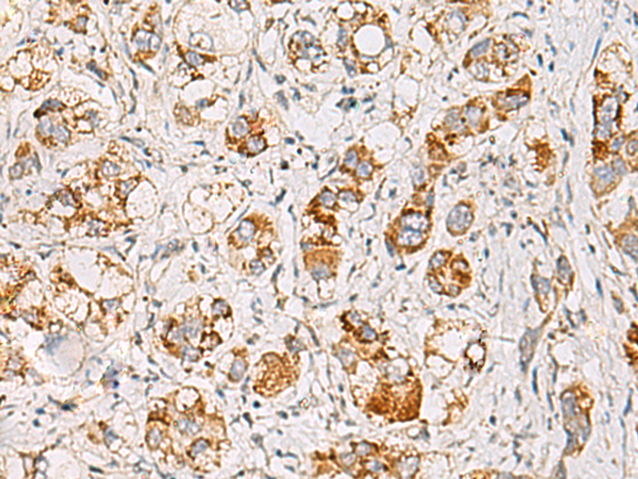 Immunohistochemistry of paraffin-embedded Human liver cancer tissue  using MMAB Polyclonal Antibody at dilution of 1:65(×200)
