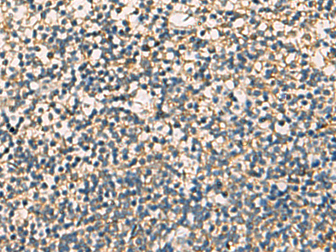 Immunohistochemistry of paraffin-embedded Human tonsil tissue  using STX6 Polyclonal Antibody at dilution of 1:60(×200)