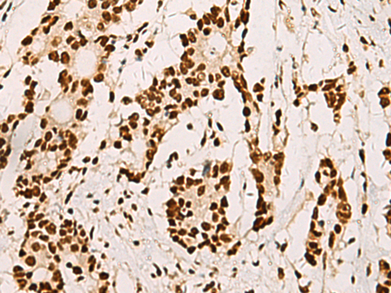 Immunohistochemistry of paraffin-embedded Human colorectal cancer tissue  using ELF5 Polyclonal Antibody at dilution of 1:70(×200)