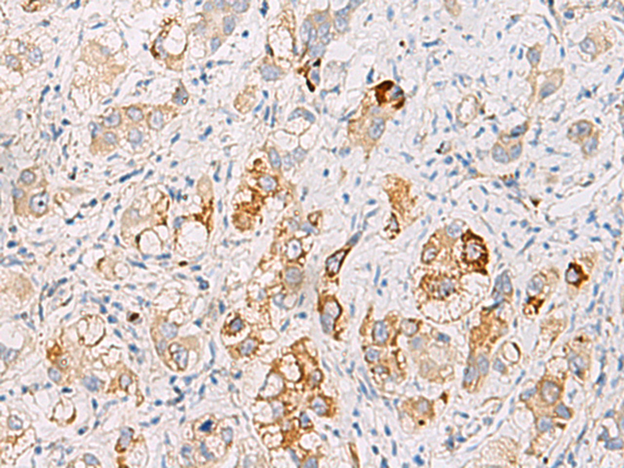 Immunohistochemistry of paraffin-embedded Human liver cancer tissue  using DHRS2 Polyclonal Antibody at dilution of 1:50(×200)