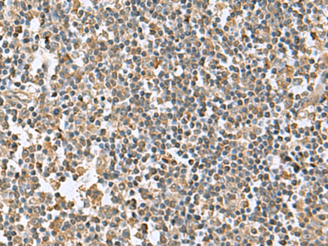 Immunohistochemistry of paraffin-embedded Human tonsil tissue  using KRCC1 Polyclonal Antibody at dilution of 1:95(×200)