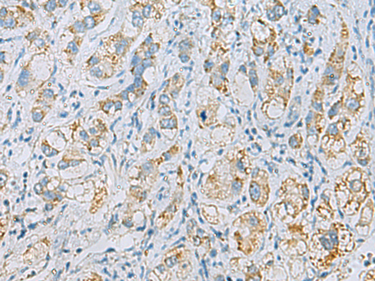 Immunohistochemistry of paraffin-embedded Human liver cancer tissue  using PLA2G15 Polyclonal Antibody at dilution of 1:65(×200)