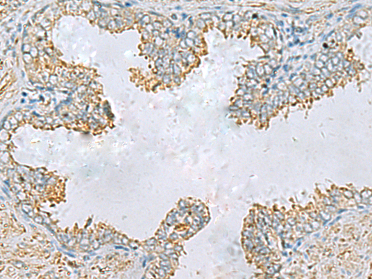 Immunohistochemistry of paraffin-embedded Human prost ate cancer tissue  using PLA2G15 Polyclonal Antibody at dilution of 1:65(×200)