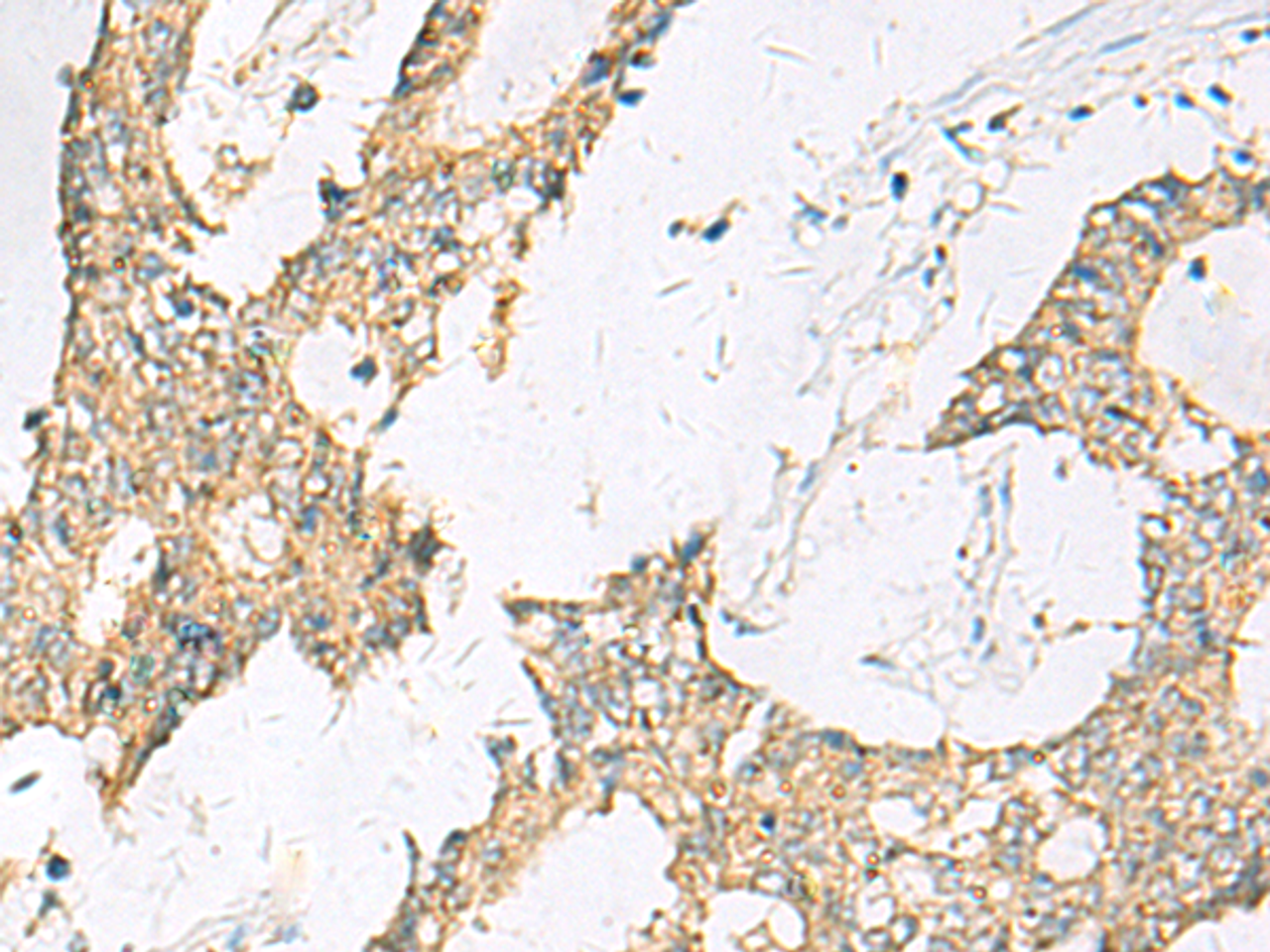 Immunohistochemistry of paraffin-embedded Human colorectal cancer tissue  using SPACA1 Polyclonal Antibody at dilution of 1:50(×200)