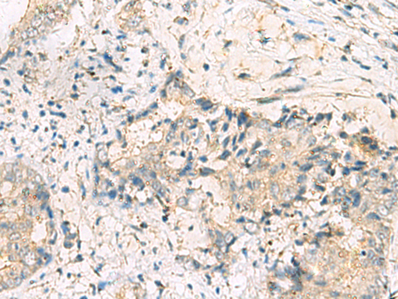 Immunohistochemistry of paraffin-embedded Human cervical cancer tissue  using MGAT4B Polyclonal Antibody at dilution of 1:50(×200)