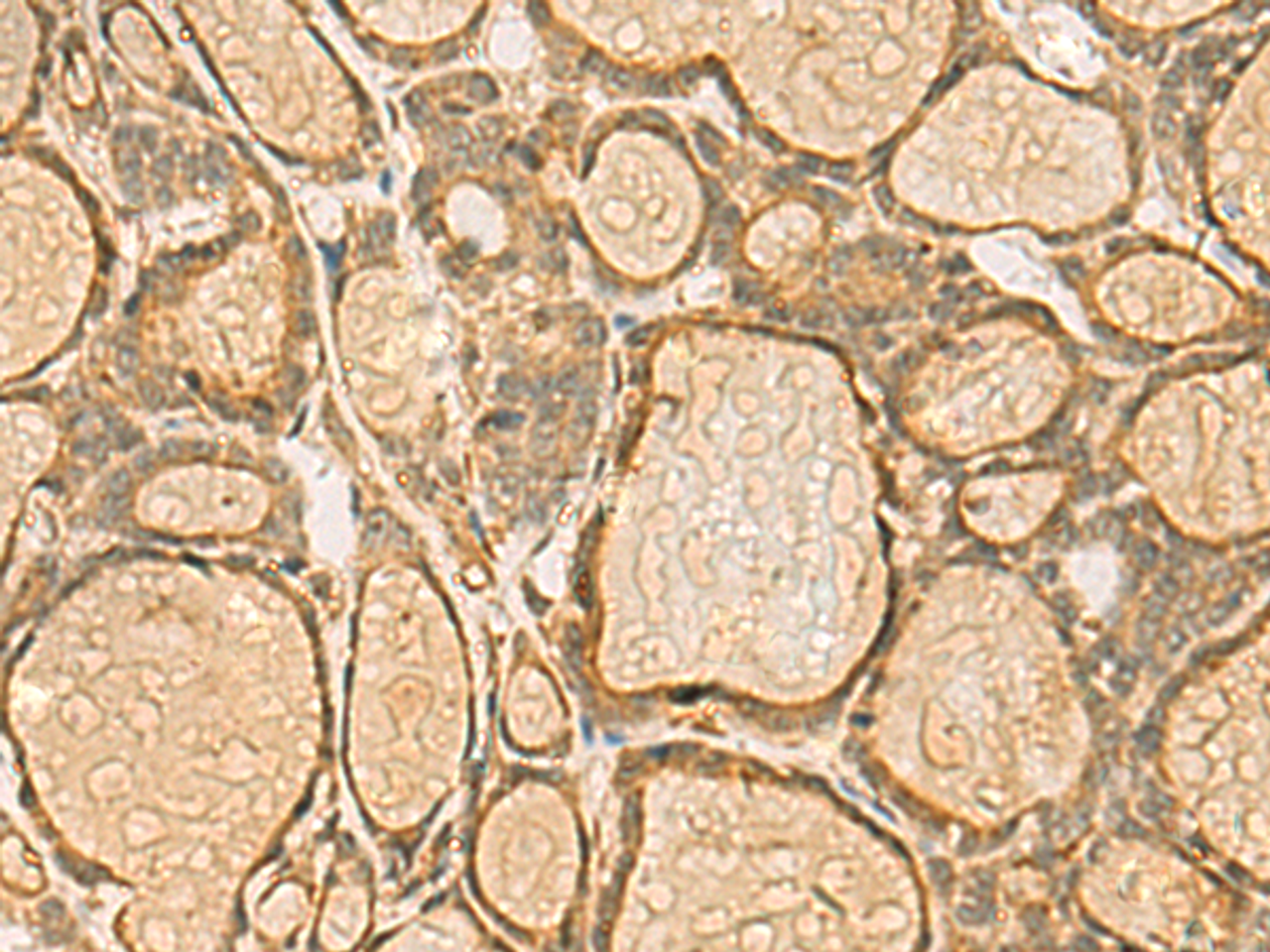 Immunohistochemistry of paraffin-embedded Human thyroid cancer tissue  using HORMAD2 Polyclonal Antibody at dilution of 1:45(×200)