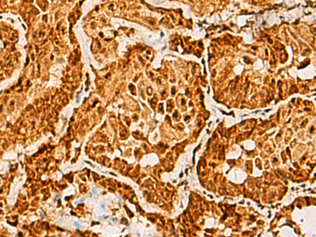 Immunohistochemistry of paraffin-embedded Human thyroid cancer tissue  using SAP30BP Polyclonal Antibody at dilution of 1:40(×200)