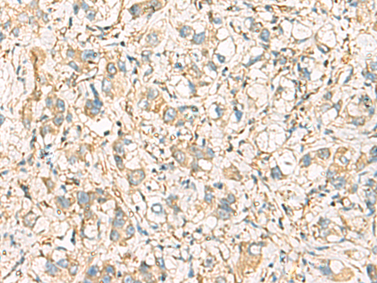 Immunohistochemistry of paraffin-embedded Human liver cancer tissue  using IDS Polyclonal Antibody at dilution of 1:60(×200)