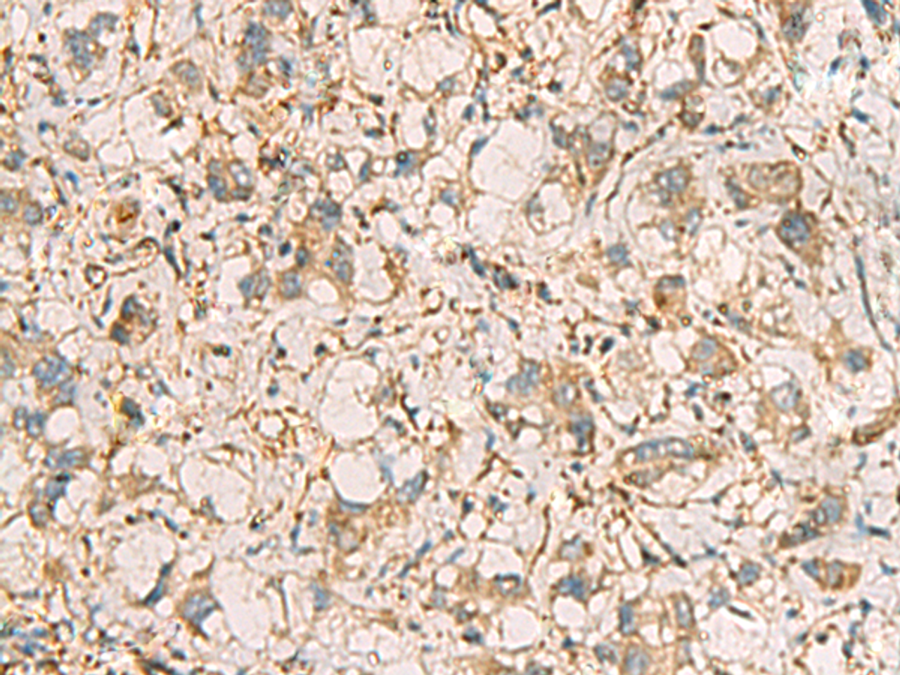 Immunohistochemistry of paraffin-embedded Human liver cancer tissue  using PRKRA Polyclonal Antibody at dilution of 1:65(×200)