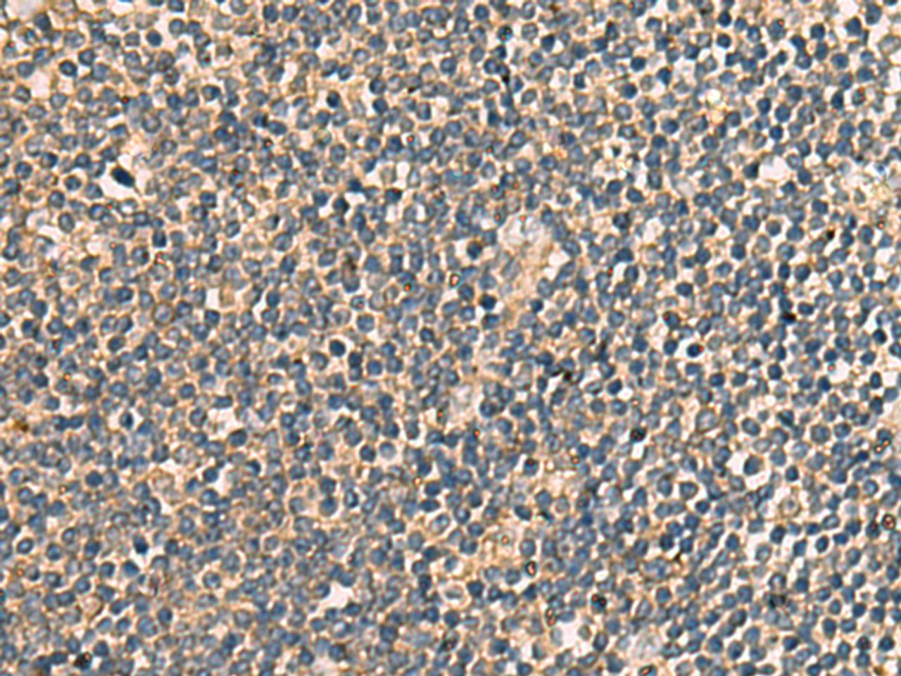 Immunohistochemistry of paraffin-embedded Human tonsil tissue  using PRKRA Polyclonal Antibody at dilution of 1:65(×200)