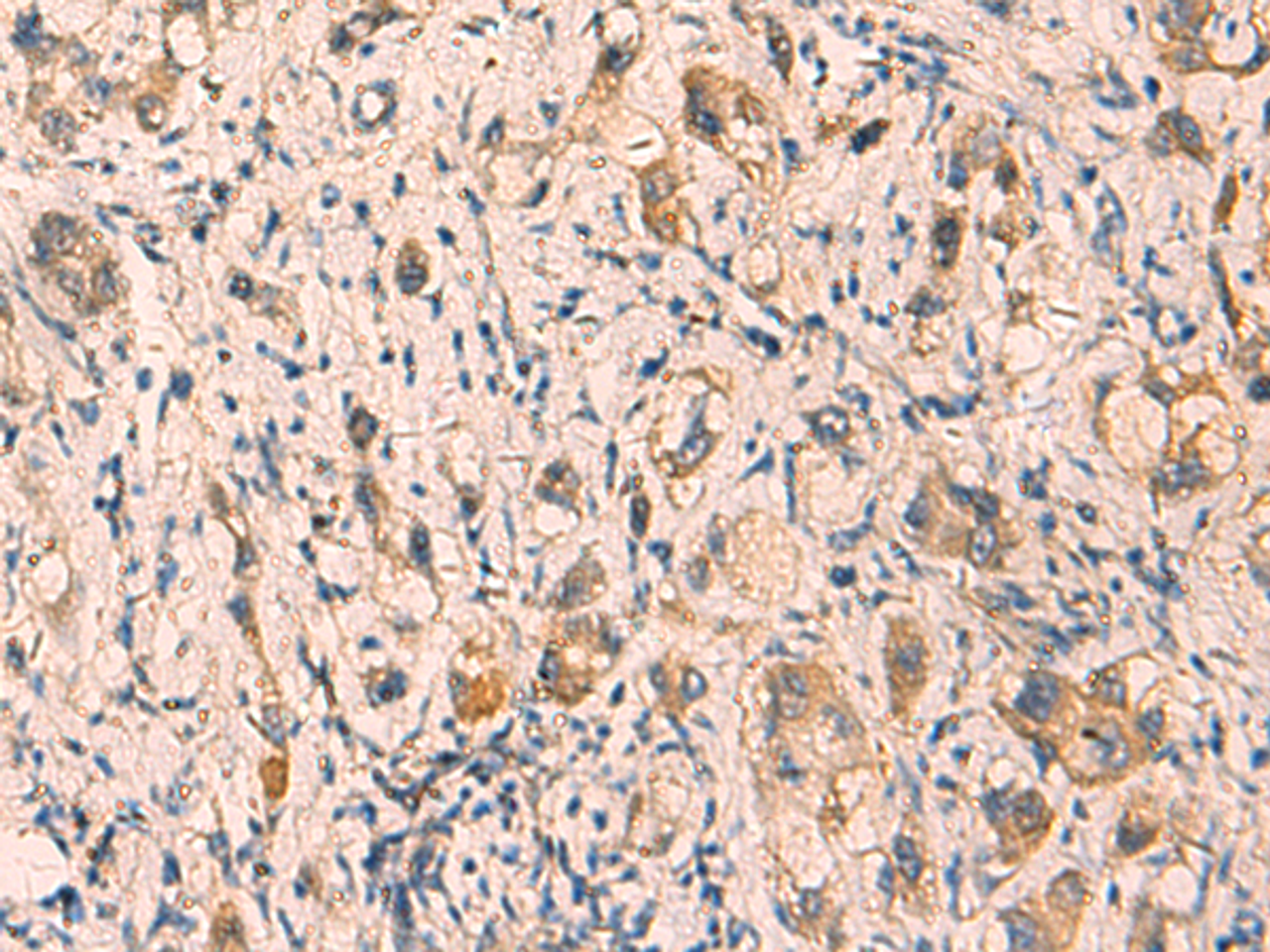Immunohistochemistry of paraffin-embedded Human liver cancer tissue  using CRYM Polyclonal Antibody at dilution of 1:65(×200)