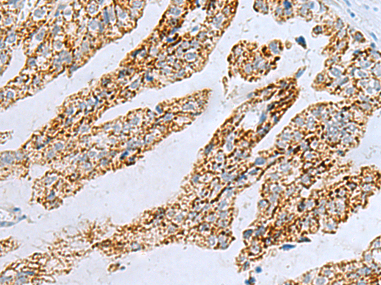 Immunohistochemistry of paraffin-embedded Human gastric cancer tissue  using PYCR2 Polyclonal Antibody at dilution of 1:40(×200)
