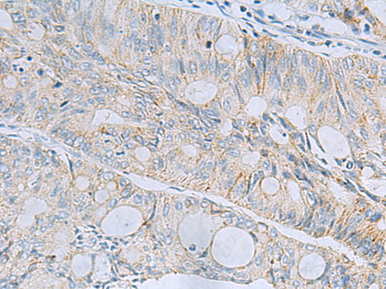 Immunohistochemistry of paraffin-embedded Human colorectal cancer tissue  using MSI2 Polyclonal Antibody at dilution of 1:60(×200)