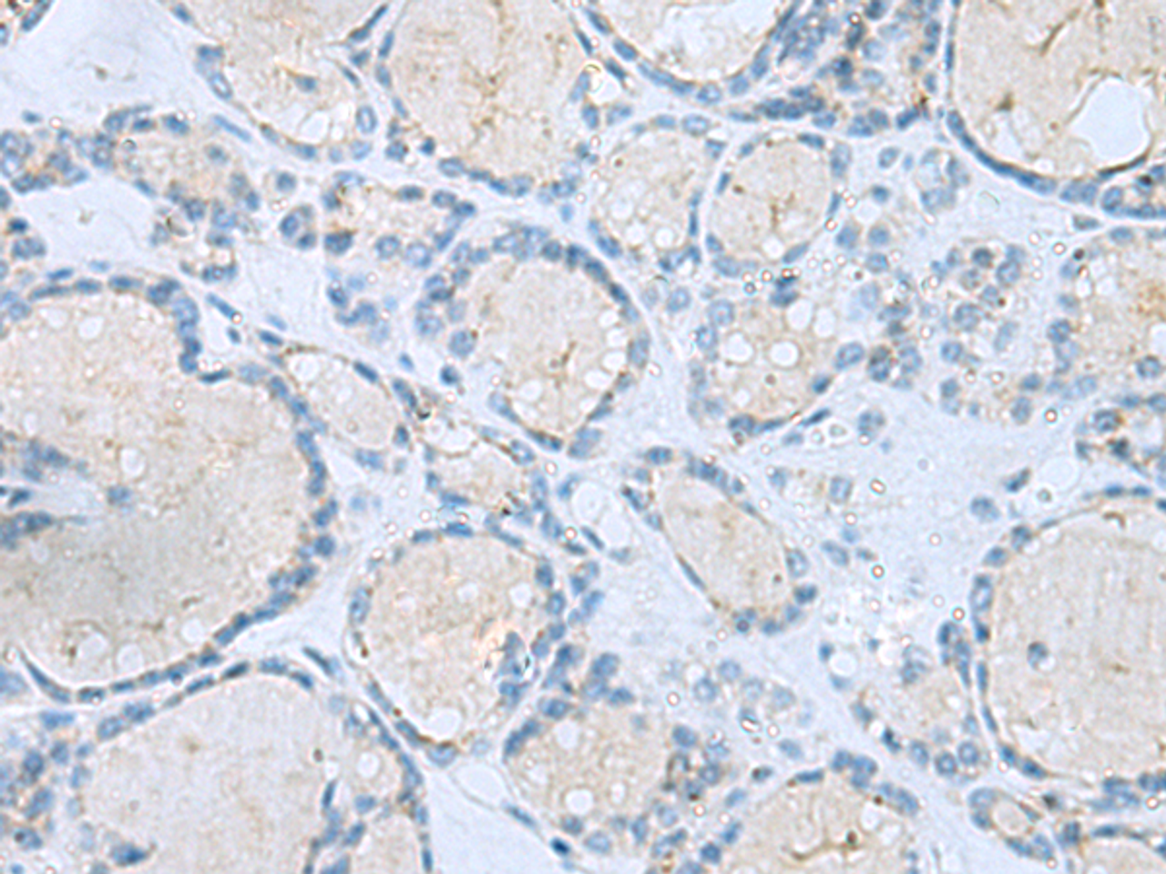 Immunohistochemistry of paraffin-embedded Human thyroid cancer tissue  using MSI2 Polyclonal Antibody at dilution of 1:60(×200)