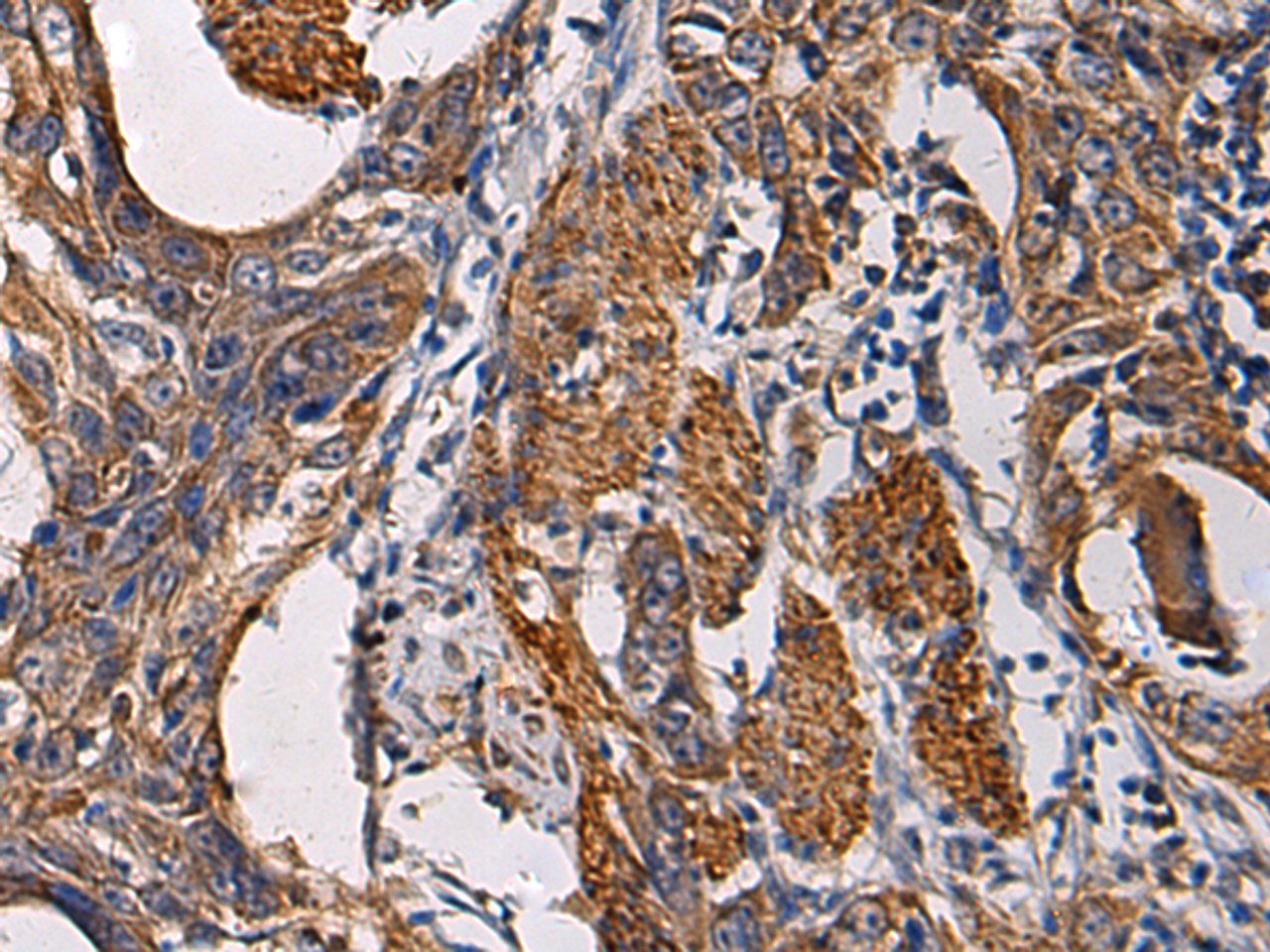 Immunohistochemistry of paraffin-embedded Human esophagus cancer tissue  using SSH3 Polyclonal Antibody at dilution of 1:60(×200)