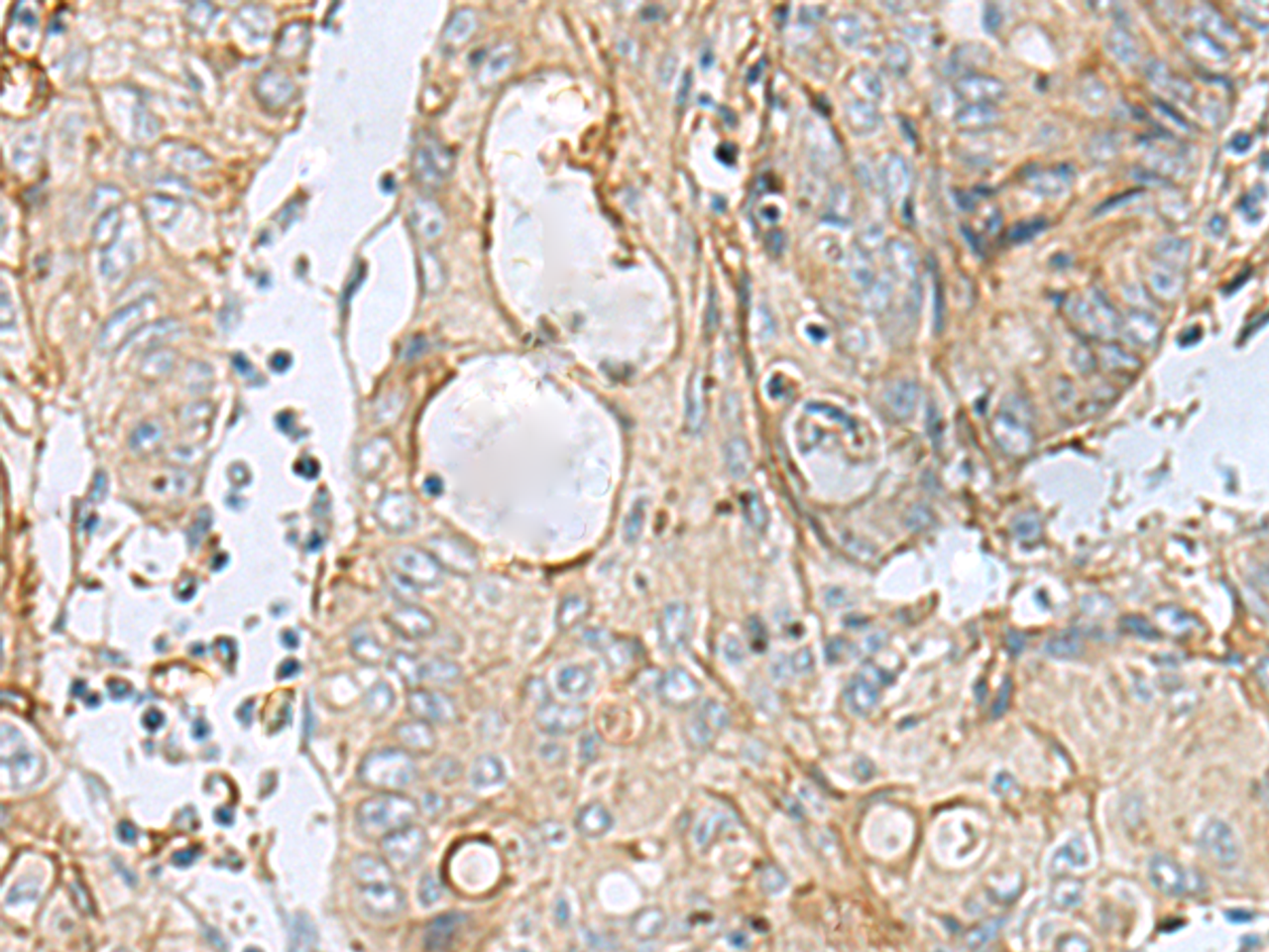 Immunohistochemistry of paraffin-embedded Human colorectal cancer tissue  using MTHFD2 Polyclonal Antibody at dilution of 1:65(×200)