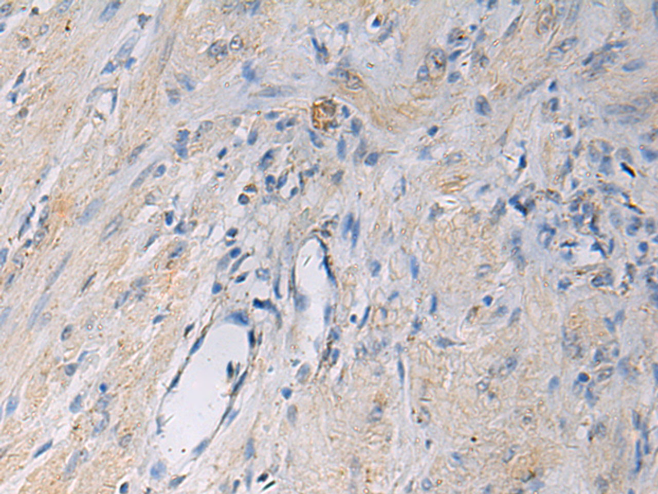 Immunohistochemistry of paraffin-embedded Human gastric cancer tissue  using HSDL2 Polyclonal Antibody at dilution of 1:55(×200)