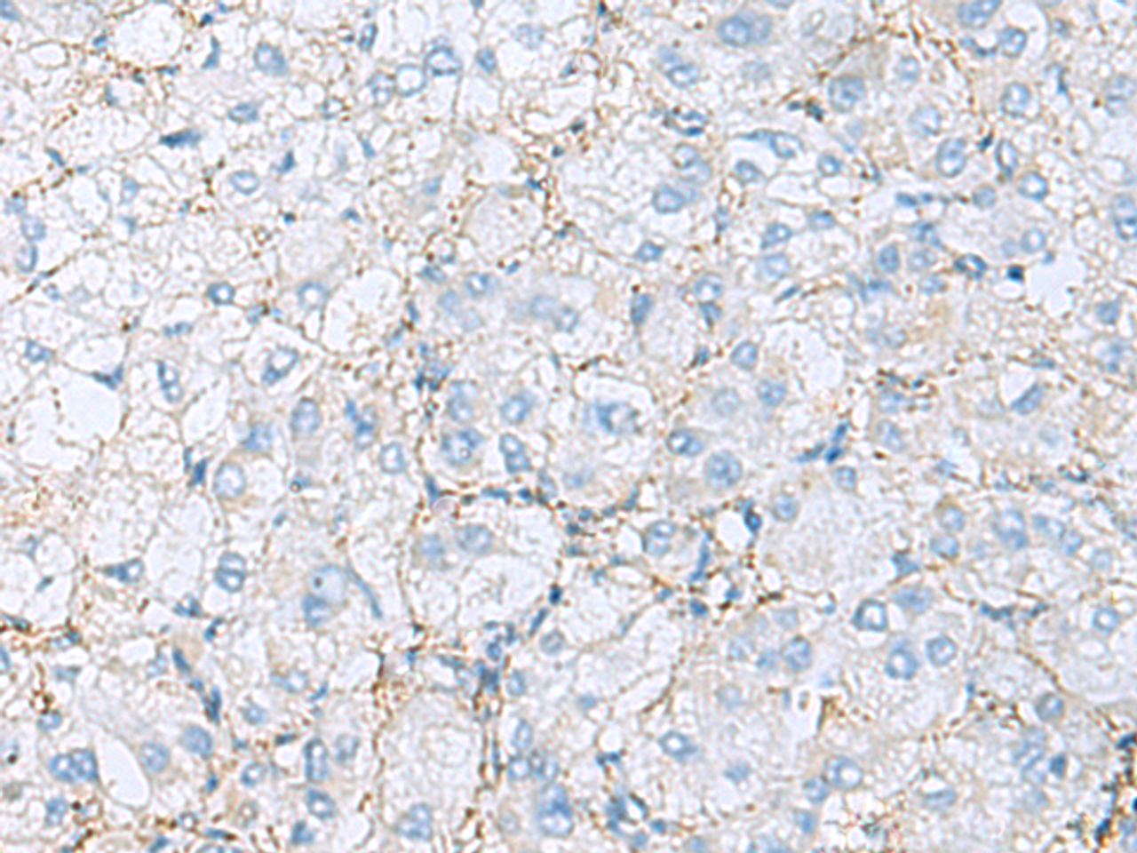 Immunohistochemistry of paraffin-embedded Human liver cancer tissue  using EMILIN1 Polyclonal Antibody at dilution of 1:70(×200)