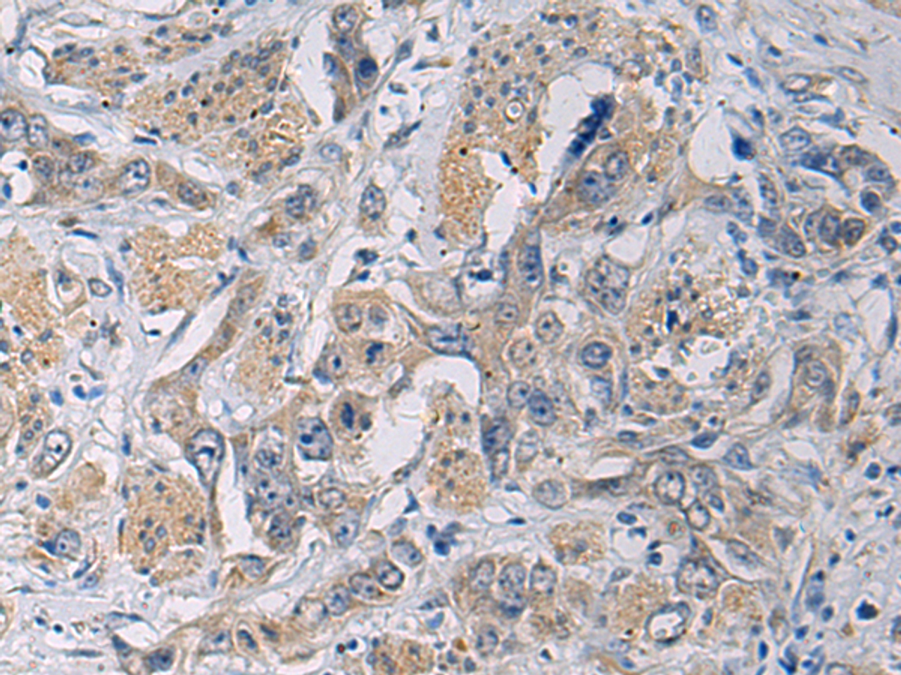 Immunohistochemistry of paraffin-embedded Human esophagus cancer tissue  using CYTIP Polyclonal Antibody at dilution of 1:50(×200)