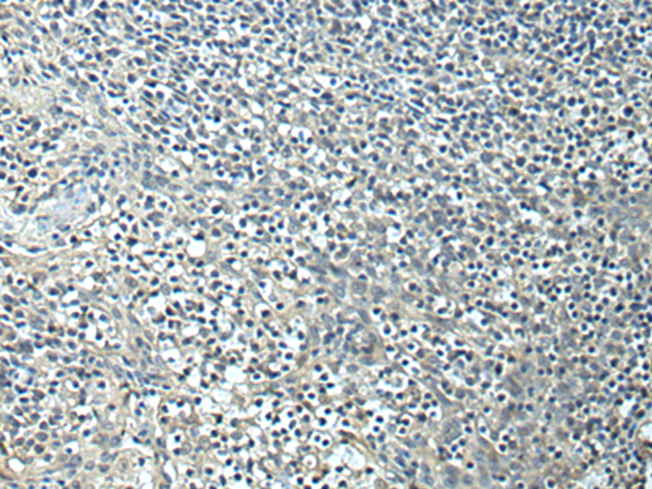 Immunohistochemistry of paraffin-embedded Human tonsil tissue  using SLC35F6 Polyclonal Antibody at dilution of 1:95(×200)