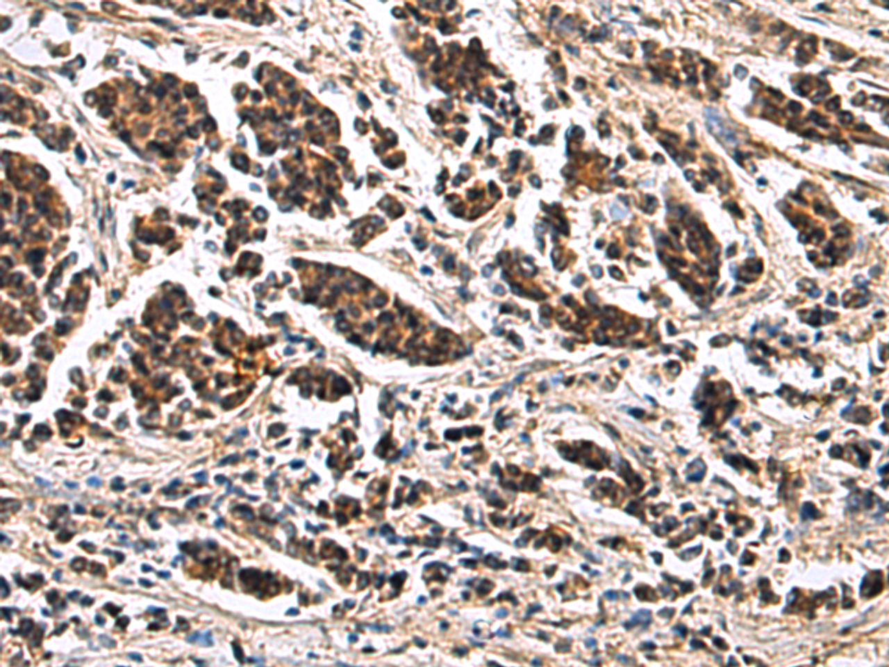 Immunohistochemistry of paraffin-embedded Human breast cancer tissue  using ARPC1B Polyclonal Antibody at dilution of 1:65(×200)