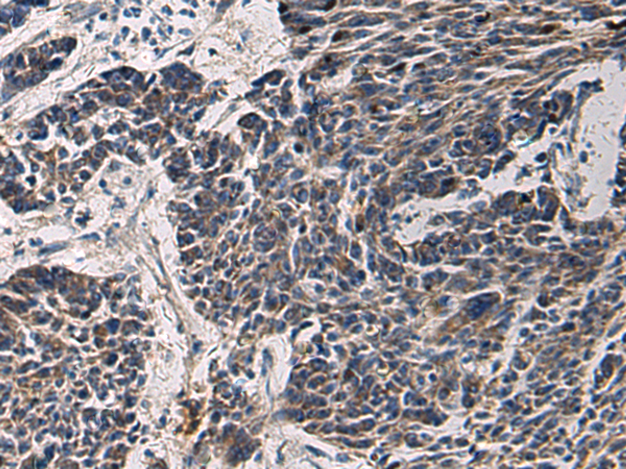 Immunohistochemistry of paraffin-embedded Human colorectal cancer tissue  using CCNI Polyclonal Antibody at dilution of 1:65(×200)