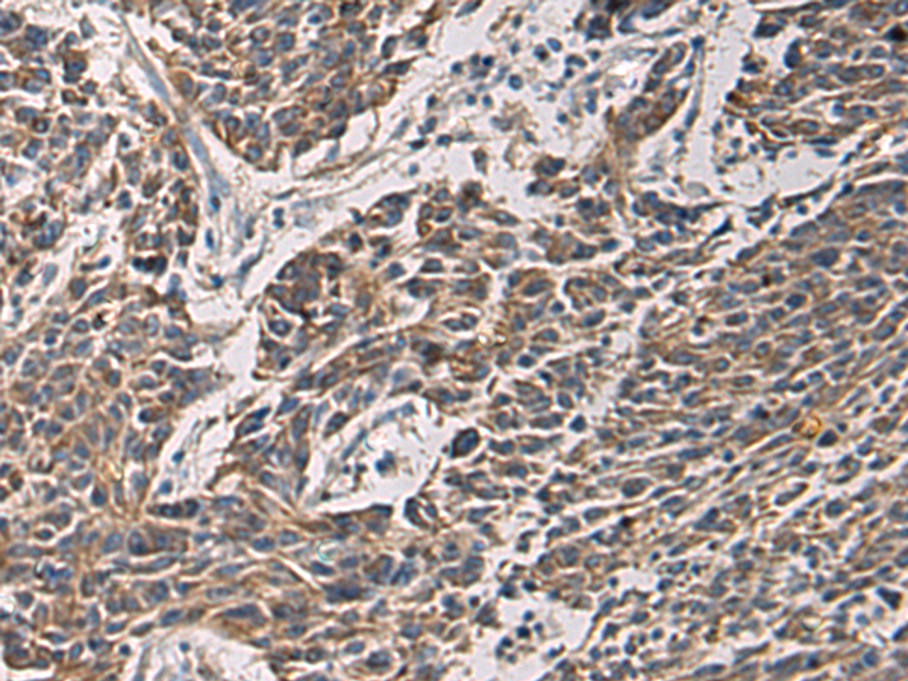 Immunohistochemistry of paraffin-embedded Human colorectal cancer tissue  using MAPKAPK3 Polyclonal Antibody at dilution of 1:95(×200)